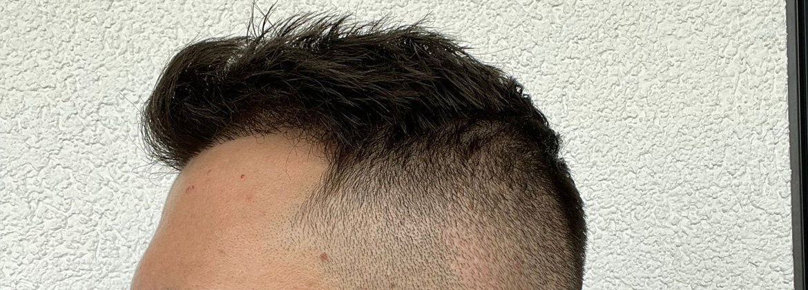 hair-plant