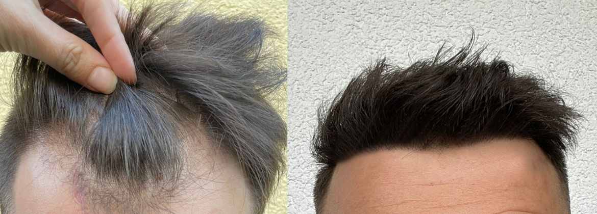 hair-plant